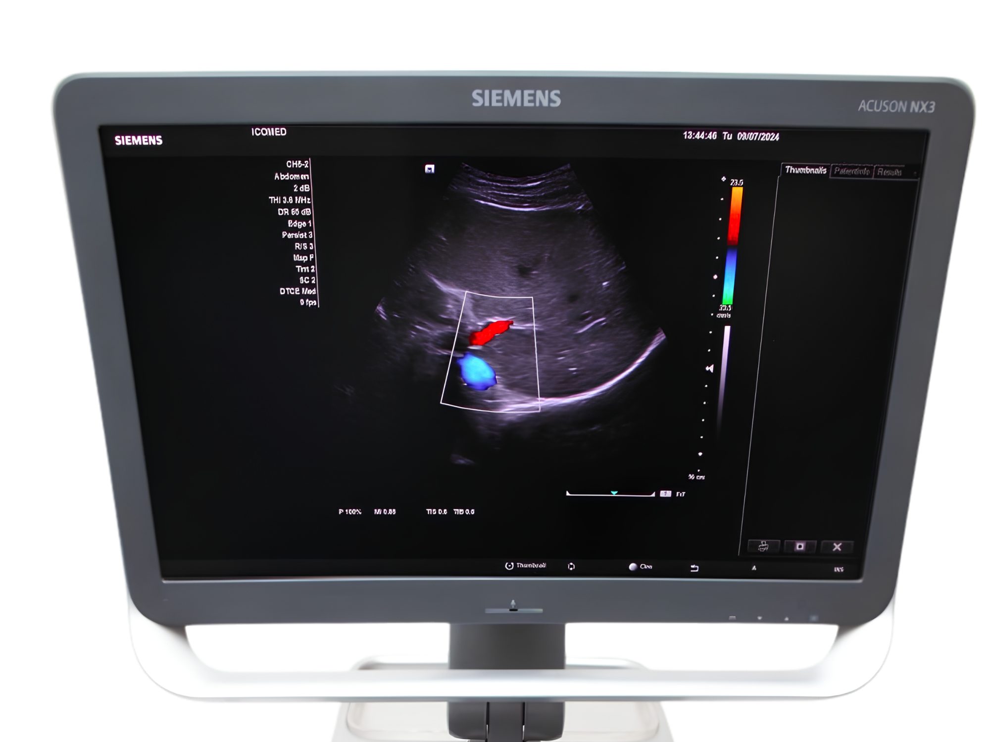 Ultrassom Siemens NX3, Ultrassom